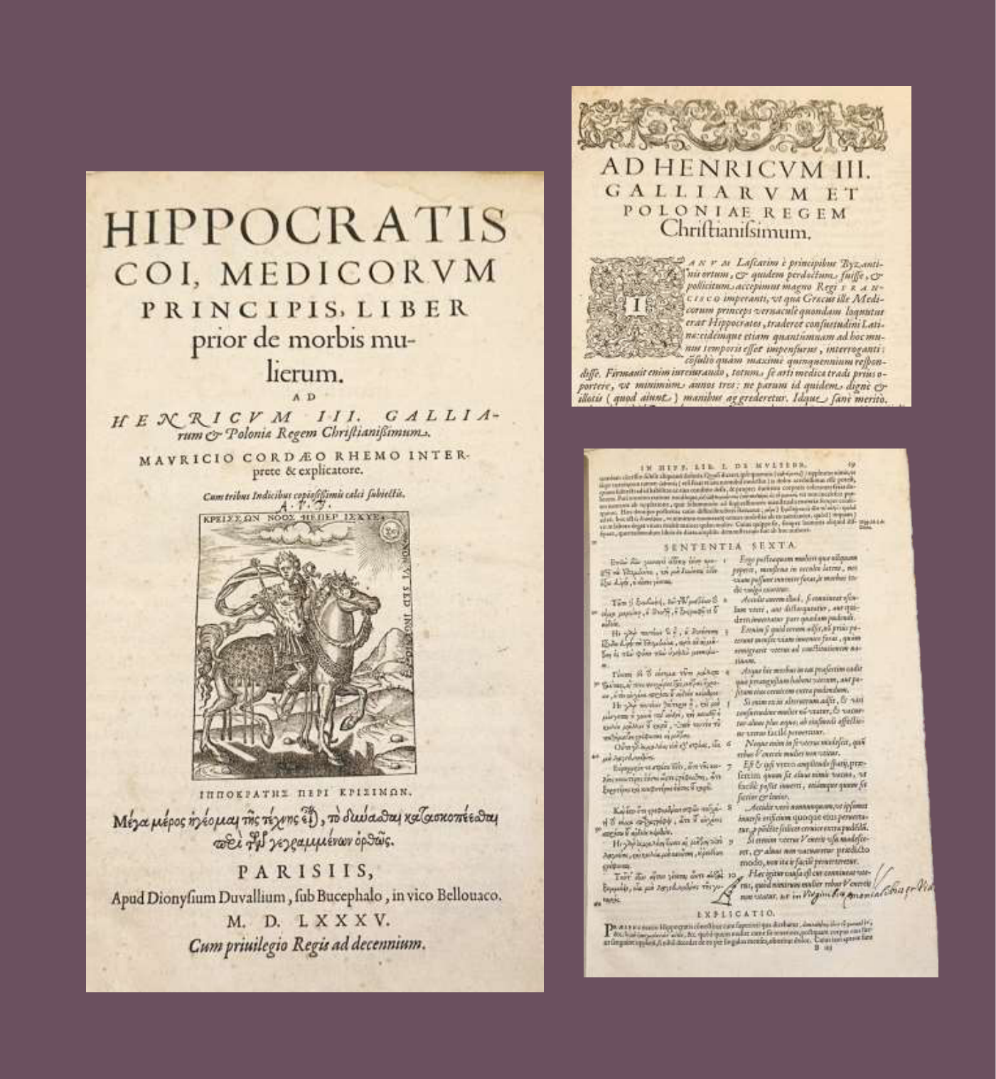 Reproducción de la portada y páginas interiores de una edición de 1585 (París, Denis Duval) de la obra de Hipócrates 'De Morbis Mulierum' (Enfermedades de las mujeres), comentada por Cordaeus. La portada, en latín y con una vistosa marca de impresor central, encabeza el conjunto; a la derecha aparecen una página de dedicatoria a Enrique III de Francia y una página de texto a doble columna en latín y griego con anotaciones manuscritas en los márgenes.